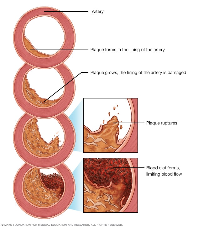 Desarrollo de aterosclerosis