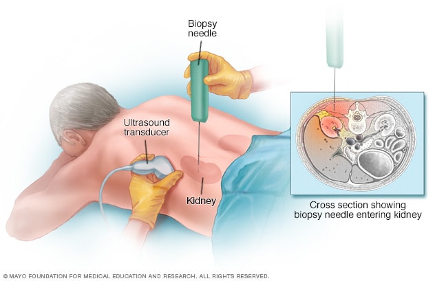 Procedimiento de la biopsia renal