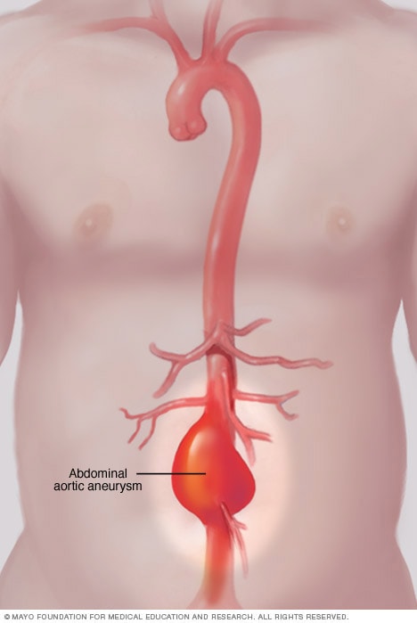 How are aortic aneurysms treated?