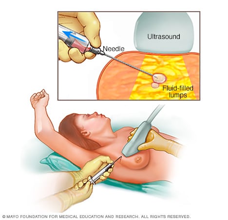 Fine-needle aspiration of the breast