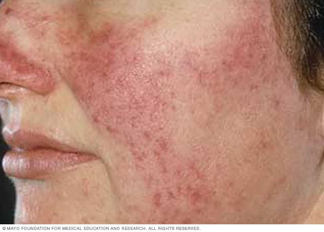 Rosacea on white skin