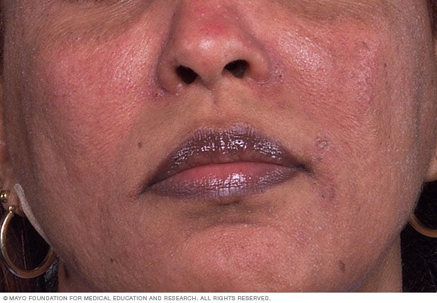 Rosacea on dark skin Mayo Clinic