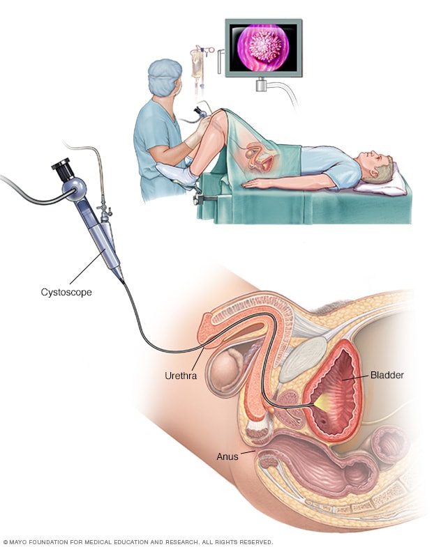 Cistoscopia que se realiza en un hombre