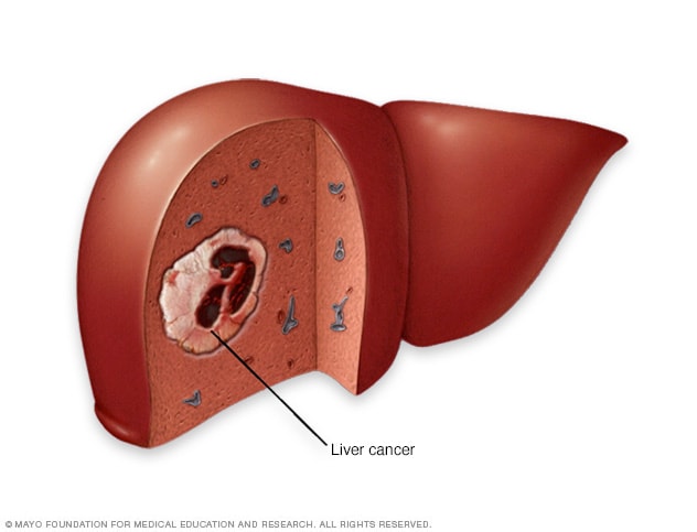 What are the early symptoms of liver cancer?