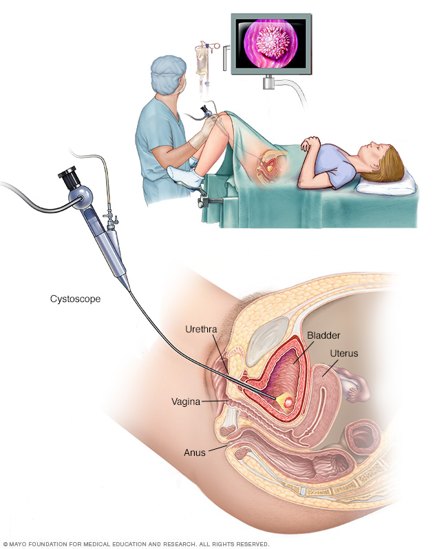 How is a cystoscopy done?