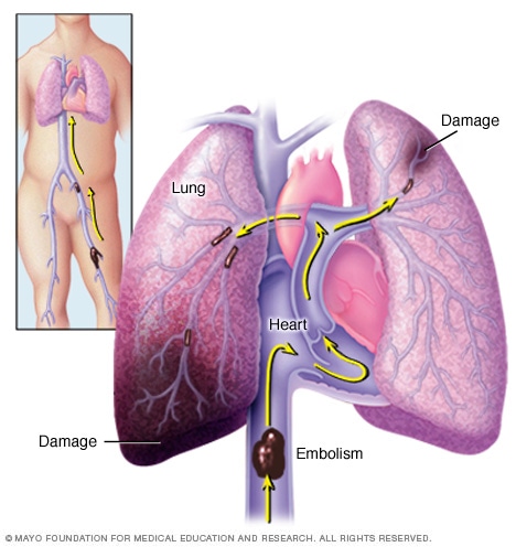 What is an embolism?