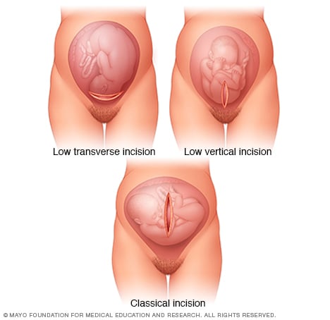 剖腹产时使用的子宫切口