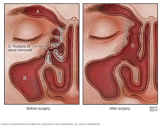 Is nasal polyp surgery serious?