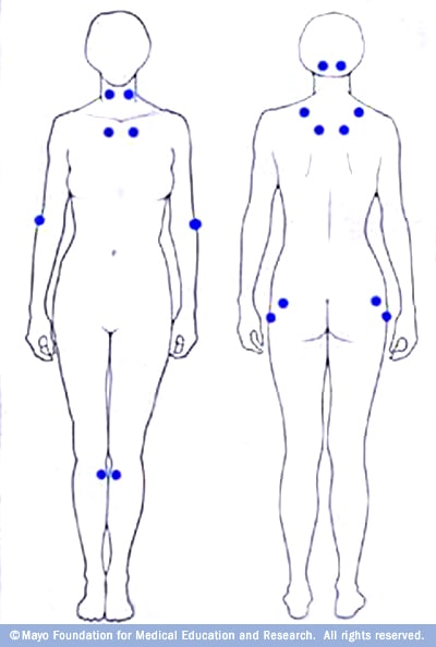 Illustration locating the 18 tender points associated with fibromyalgia 

