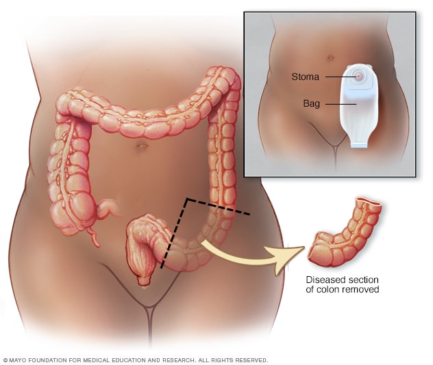 Colostomy surgery for colon cancer