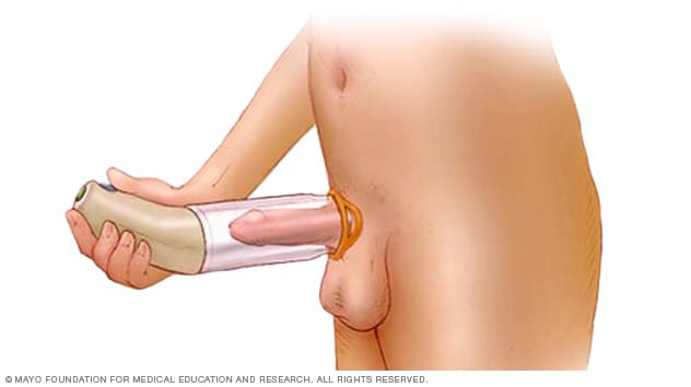 Battery-powered penis pump for erectile dysfunction