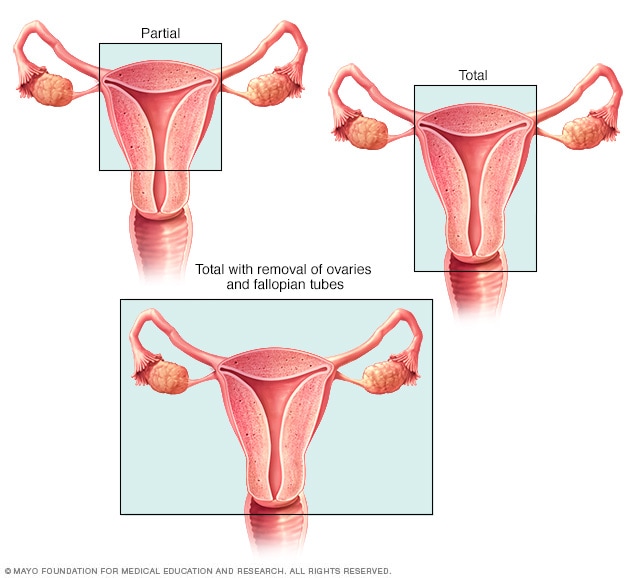 子宫切除术的类型