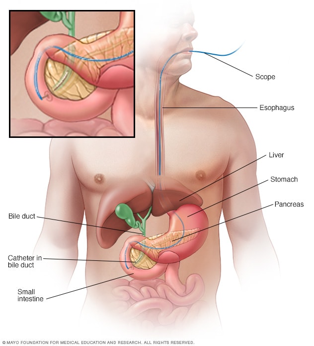 Procedimiento de colangiopancreatografía retrógrada endoscópica