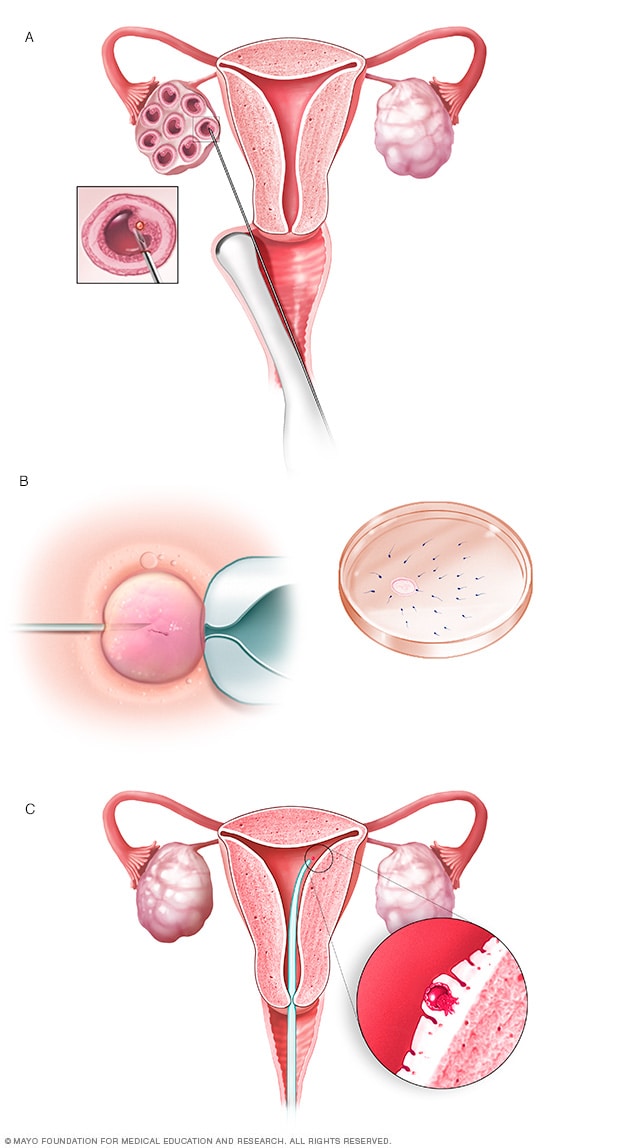 Ilustración del proceso de fertilización in vitro