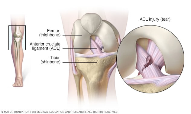 What is a common reason for a torn knee ligament?