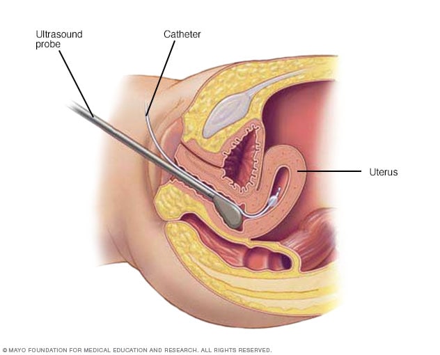 显示在宫腔造影过程中会发生的情况的图示