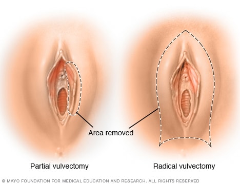 Vulvectomía parcial y vulvectomía radical 