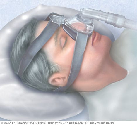 Máscara de presión positiva continua en las vías respiratorias (CPAP)