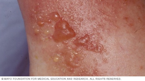 يمثل الطفح الجلدي الناتج عن اللبلاب السام أحد أنواع التهاب الجلد التماسي التحسسي.
