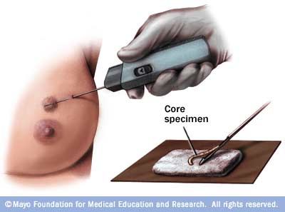 Image showing core needle biopsy
