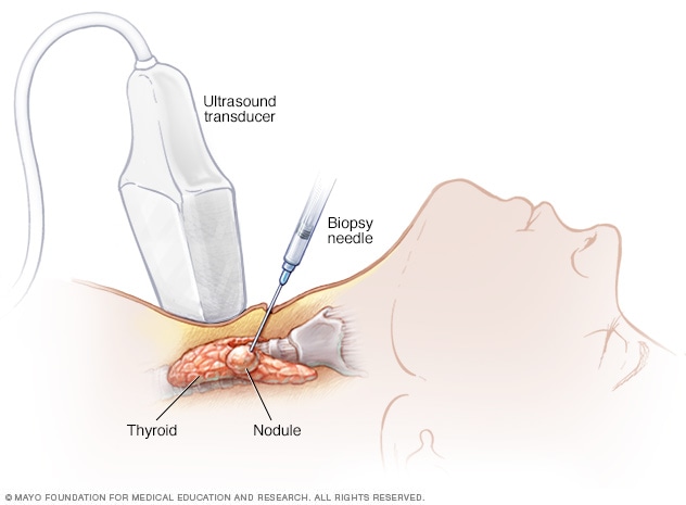 Illustration showing thyroid biopsy