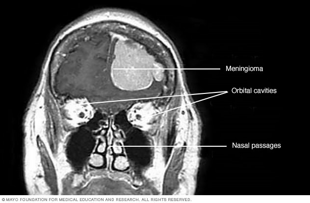显示脑膜瘤的计算机断层成像（CT）扫描