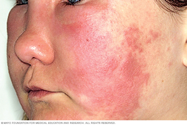 angioedema-mayo-clinic