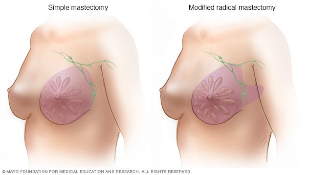 Mastectomía simple y radical modificada 