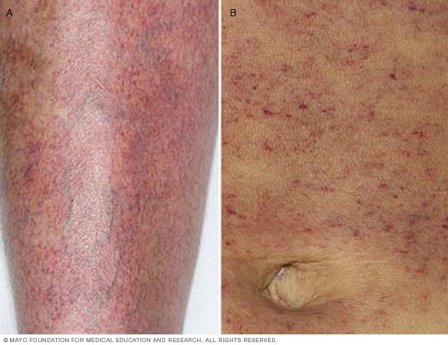 Idiopathic Thrombocytopenic Purpura Itp Symptoms And Causes Mayo