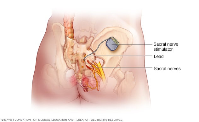 Dispositivo de estimulación nerviosa implantado