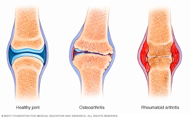 Diferencia entre osteoartritis y artritis reumatoide