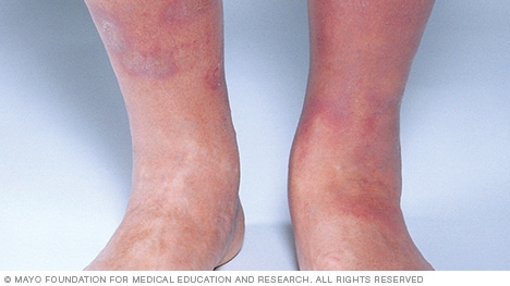 Dermatitis por estasis
