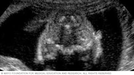 تُظهر أشعة تصوير الجنين بالموجات فوق الصوتية مقطعًا عرضيًا من الجزء العنقي من العمود الفقري
