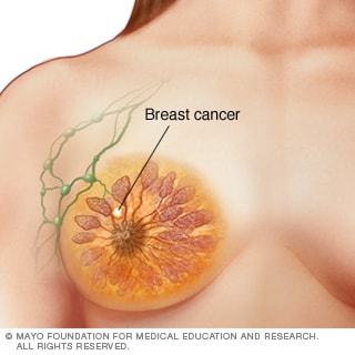 Illustration of stage I breast cancer