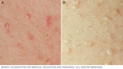 Two examples of heat rash