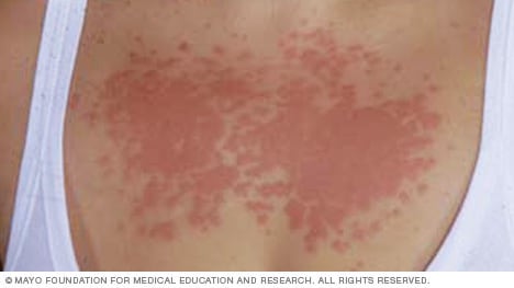 An example of skin affected by polymorphous light eruption