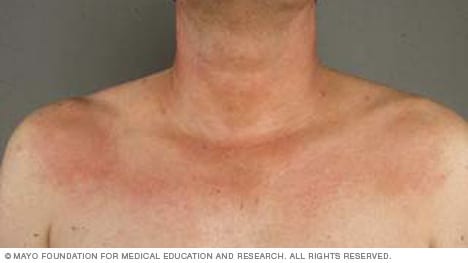 An example of the rash caused by a ragweed plant