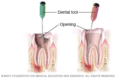 Illustration showing removal of decayed pulp during root canal