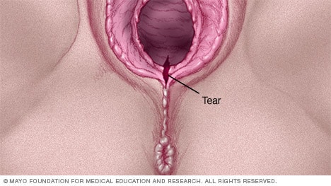 Ilustración de un desgarro vaginal de primer grado