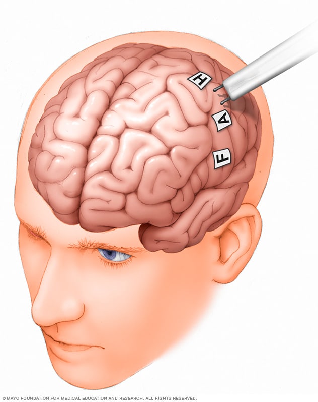 إجراء رسم خرائط الدماغ