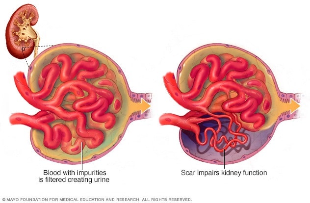 Glomérulos en los riñones que muestran un glomérulo normal y uno con cicatrices