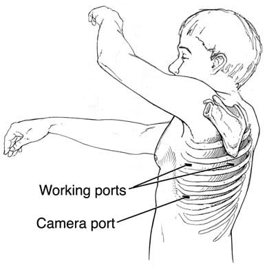Diagram indicating skin incisions used for VATS