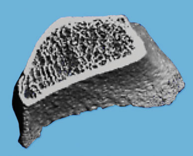 HRpQCT scan of outer ring of cortical bone and inner trabecular microarchitecture of distal radius