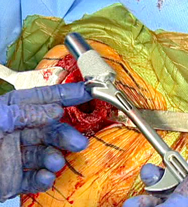 Photo of newer bone-preserving ultrashort humeral component