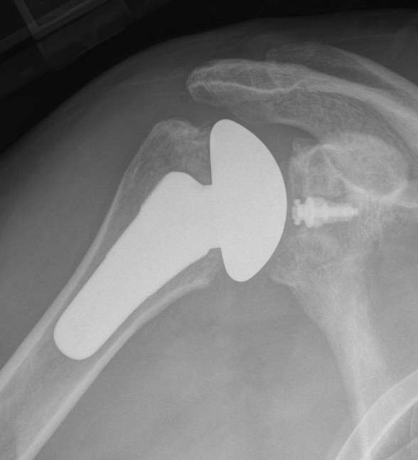 Radiograph after total shoulder arthroplasty with an ultrashort stem and a modern hybrid glenoid component