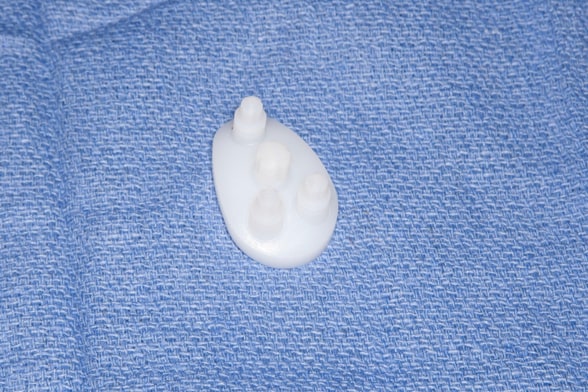 Photo of bone-preserving glenoid component
