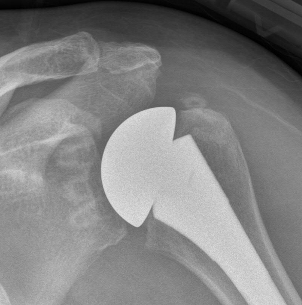 Radiograph of implant showing minimal bone is needed for implantation of new glenoid components