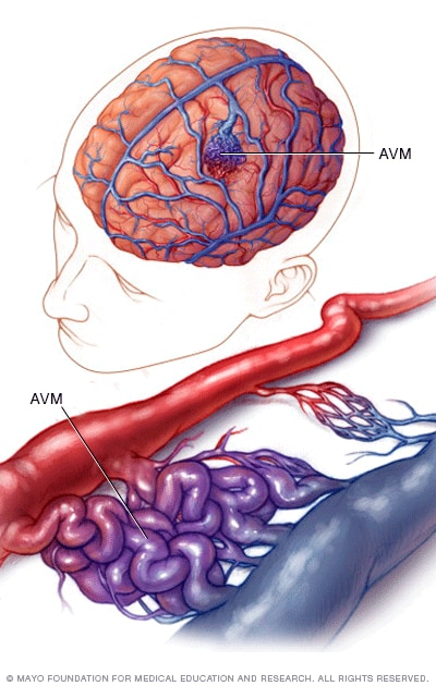 الأوعية الدموية في التشوّه الشرياني الوريدي الدماغي