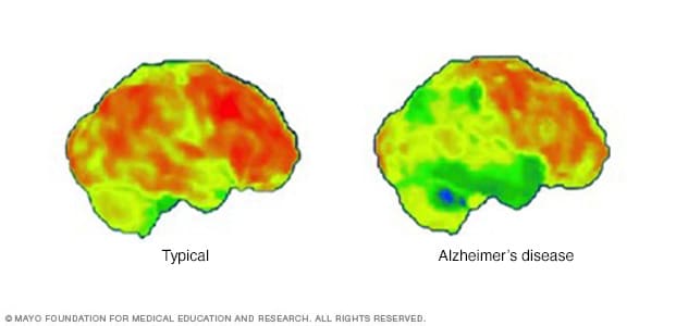 Tomografías por emisión de positrones del cerebro en el caso de la enfermedad de Alzheimer