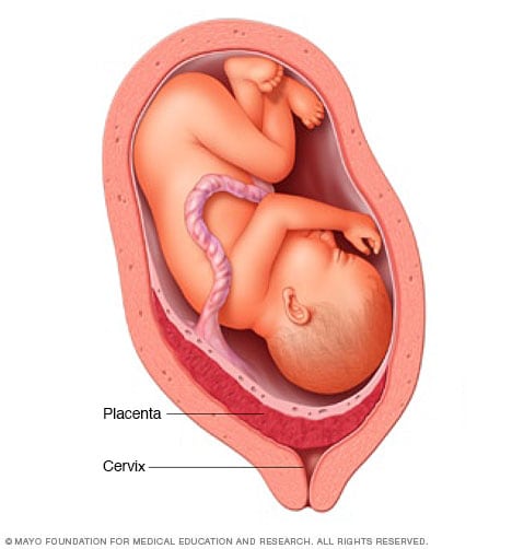 Placement of placenta in placenta previa